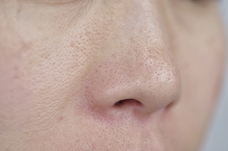 毛穴の開きにエクソソーム導入が効く！エレクトロポレーションと成分で実感できる結果