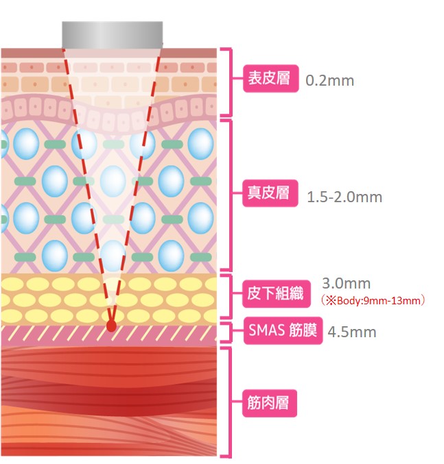 CRYO HIFU3